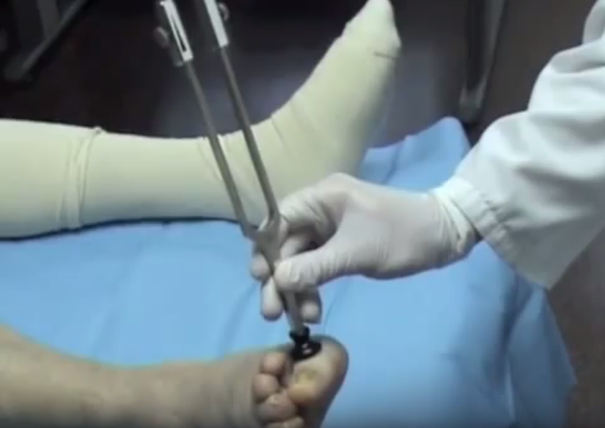 Exploración neuropática del pie diabético Sensibilidad profunda