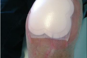 Herida en rodilla tratada con apósito combinado de espuma hidrocelular con adhesivo de silicona y capa enmascaradora de exudado