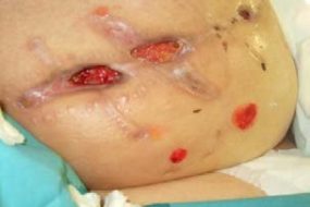 Tratamiento combinado en una herida por dehiscencia postquirúrgica